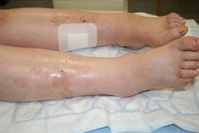 Figure 10 – Soft pitting oedema with shiny, stretched skin in heart failure